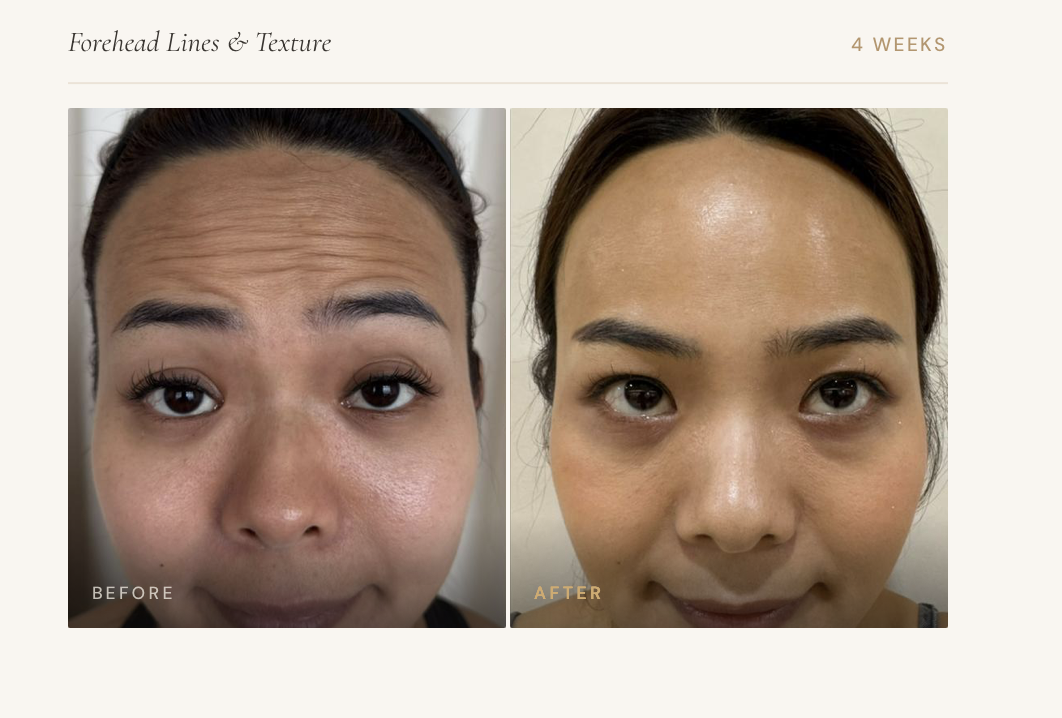 Forehead Lines and Texture — Before and After 4 Weeks